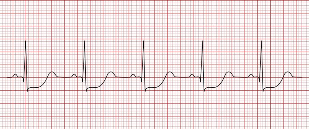 angina de pecho y el infarto